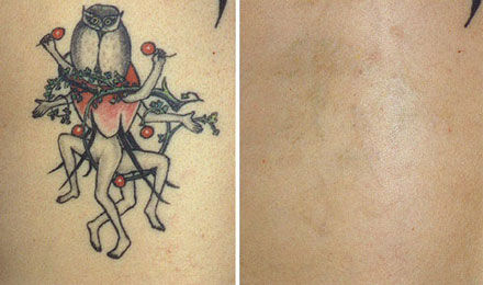 Tattoo Removal: Before and Afters Lexington KY